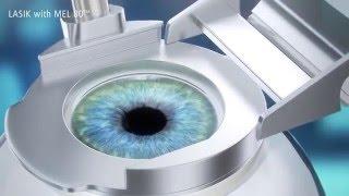 LASIK-Augenlaser OP-Behandlung (Mikrokeratom) in Wien-Zürich bei EyeLaser