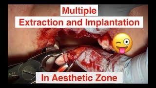 Multiple Extraction and Implants in Aesthetic Zone