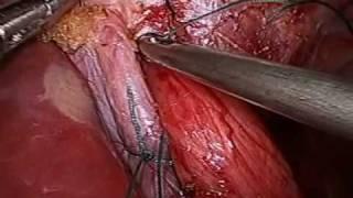 laparoscopic fundoplication for heartburn by Dr Craig Taylor Sydney