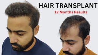 Hair transplant in bhopal | Best cost and results in bhopal