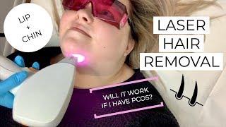 I GOT LASER HAIR REMOVAL ON MY LIP AND CHIN | PCOS | SPADERMA CHICAGO