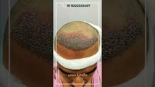 Hair Transplant in Mumbai | Hair Transplant in India