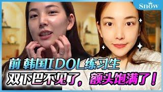 前韓國IDOL練習生! 雙下巴吸脂+額頭脂肪填充 VLOG