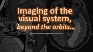 Imaging of the visual system... beyond the orbits!