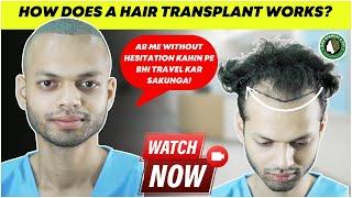 HOW DOES A HAIR TRANSPLANT WORKS? | BEST HAIR TRANSPLANT IN ASSAM