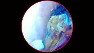 Tympanic membrane perforation and postoperative debridement for cholesteatoma #73