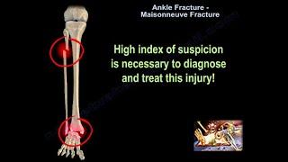 Ankle Fracture Maisonneuve Fracture - Everything You Need To Know - Dr. Nabil Ebraheim