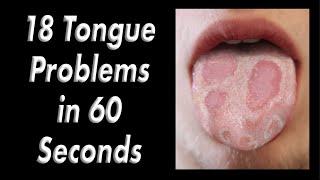 18 Tongue Problems in 60 Seconds