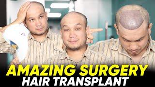 Hair Transplant in Bikaner | Best Results & Cost of Hair Transplant in Bikaner