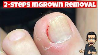 HOW TO REMOVE AN INGROWN TOENAIL