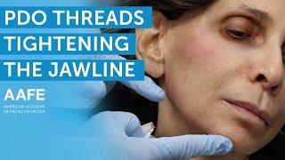 PDO Thread Lift to Create a Snatched Jawline | AAFE