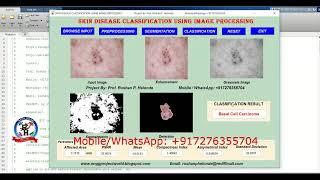 Skin Disease Classification Using Matlab | Skin Disease Detection Using Machine Learning Source Code