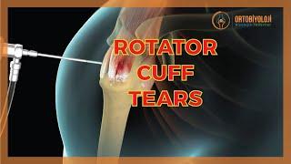 ROTATOR CUFF TEARS