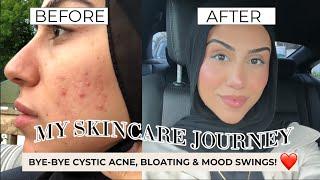 My Skincare Journey | PCOS, Cystic Acne, Gut Health & Healing my  Inner Self  ️