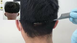 11 Months Before and After Hair Transplant | SMART™ FUE at Glojas Clinic