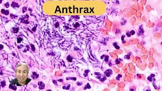 Anthrax enterocolitis