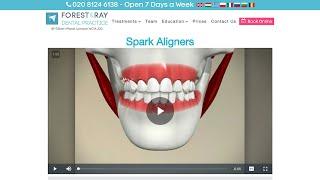 Spark Aligners London - Forest & Ray - Dentists, Orthodontists, Implant Surgeons