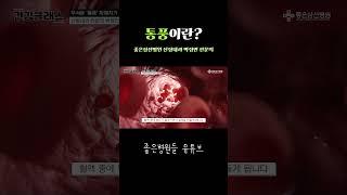 통풍이란 무엇인가?