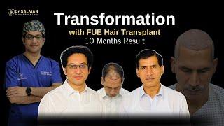 Witness Magical Transformation of Dr. Usman with FUE Hair Transplant done by Dr. M Salman Khan #fue