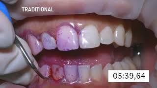 Abrasive teeth cleaning method  vs AIRFLOW method - Studio Odontoiatrico Dott.ssa Rosa Multari