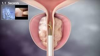 Rezum Water Vapor Therapy for Prostate Enlargement / Prostat Büyümesinde Rezum Su Buharı Tedavisi