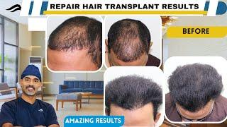 Hair Transplant In Chennai | Best Clinic  Surgeon Center & Results Of Hair Transplant Of Chennai