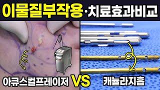 불법이물질제거 방법에 따른 효과 알려드립니다! #필러부작용#이물질부작용