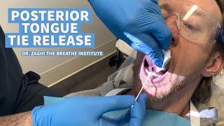 POSTERIOR TONGUE TIE RELEASE WITH DR. ZAGHI AT THE BREATHE INSTITUTE