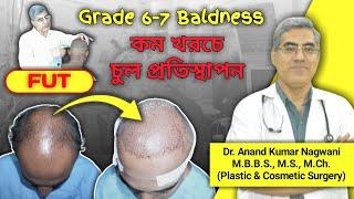 Grade 6-7 Baldness || Covered Total Area of Baldness || Cheapest Hair Transplant in Kolkata