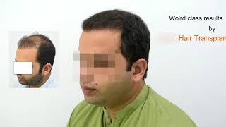 Corrective hair transplant surgery by Dr M jawad Chaudhry