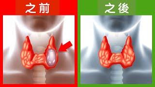 縮小甲狀腺結節自然療法,柏格醫生 Dr Berg