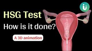 What is HSG test and how is it done? A 3D medical animation