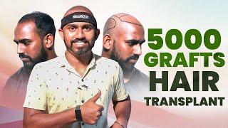 5000 Grafts to Confidence: My Hair Transplant Story  | New Roots | Hyderabad