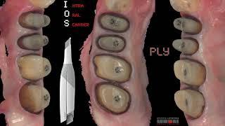 BOPT & Intra Oral Scanner