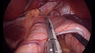 Dr Craig Taylor performing a Gastric Sleeve OClinic Sydney Australia