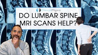 Are MRI Scans Always Helpful in the Diagnosis of Low Back Pain? | Expert Physio Reviews the Evidence