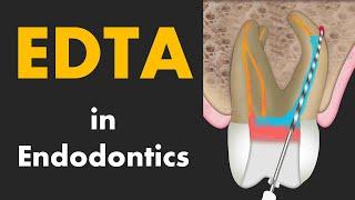 EDTA in Root Canal Treatment