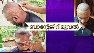 Bandage Removal After Hair Transplant | Hair Transplant Bandage Removal at Home | RIGHT-TIME