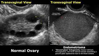 Ovary Ultrasound Normal Vs Endometrioma Imaging Findings | Chocolate Cyst. Ground Glass Appearance