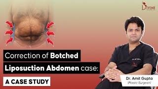 Correction of Botched Liposuction Abdomen Case : A Case Study | Dr Amit Gupta