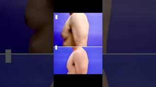 Gynecomastia Before And After | Avance Plastic Surgery Institute: Dr. Erez Dayan | Reno, NV