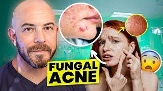 The Best Fungal Acne Treatments Of 2024