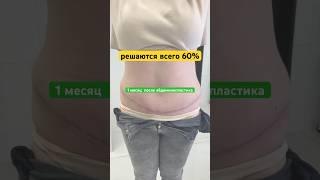 #абдоминопластика #пластическаяоперация