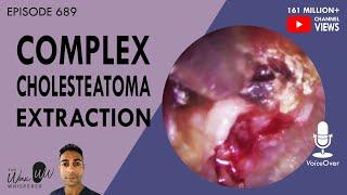 689 - Complex Cholesteatoma Extraction