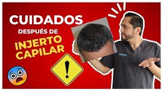 3 Cuidados Post  INJERTO CAPILAR | Para NO HACERTE un Injerto 