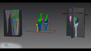 Robust Metal Implant and Anatomical Segmentation Tool by RSIP Vision