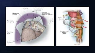 Extended Retrosigmoid Craniotomy for Resection of a Petrotentorial Meningioma