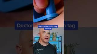 Doctor reacts to DIY mole removal! #mole #skincancer #dermreacts #doctorreacts