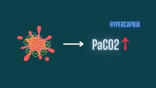 Hypercapnia: Pathophysiology Of CO2 Retention