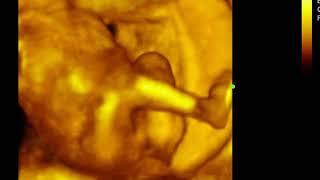 CASE 770 2D 3D 4D ultrasound uterine contraction in pregnancy